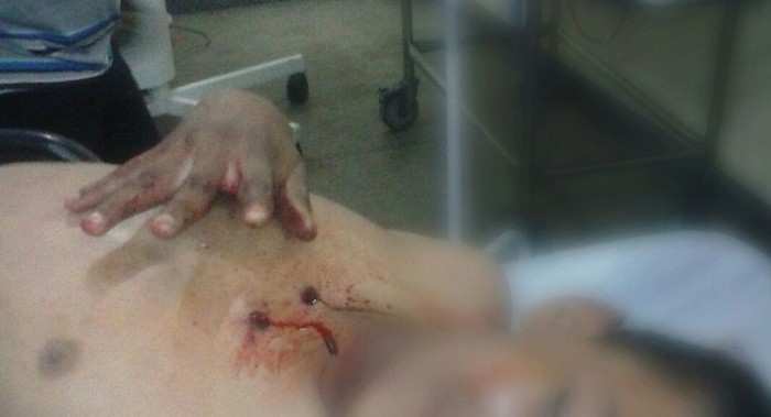 Adolescente recebeu tiros de garrucha no tórax 